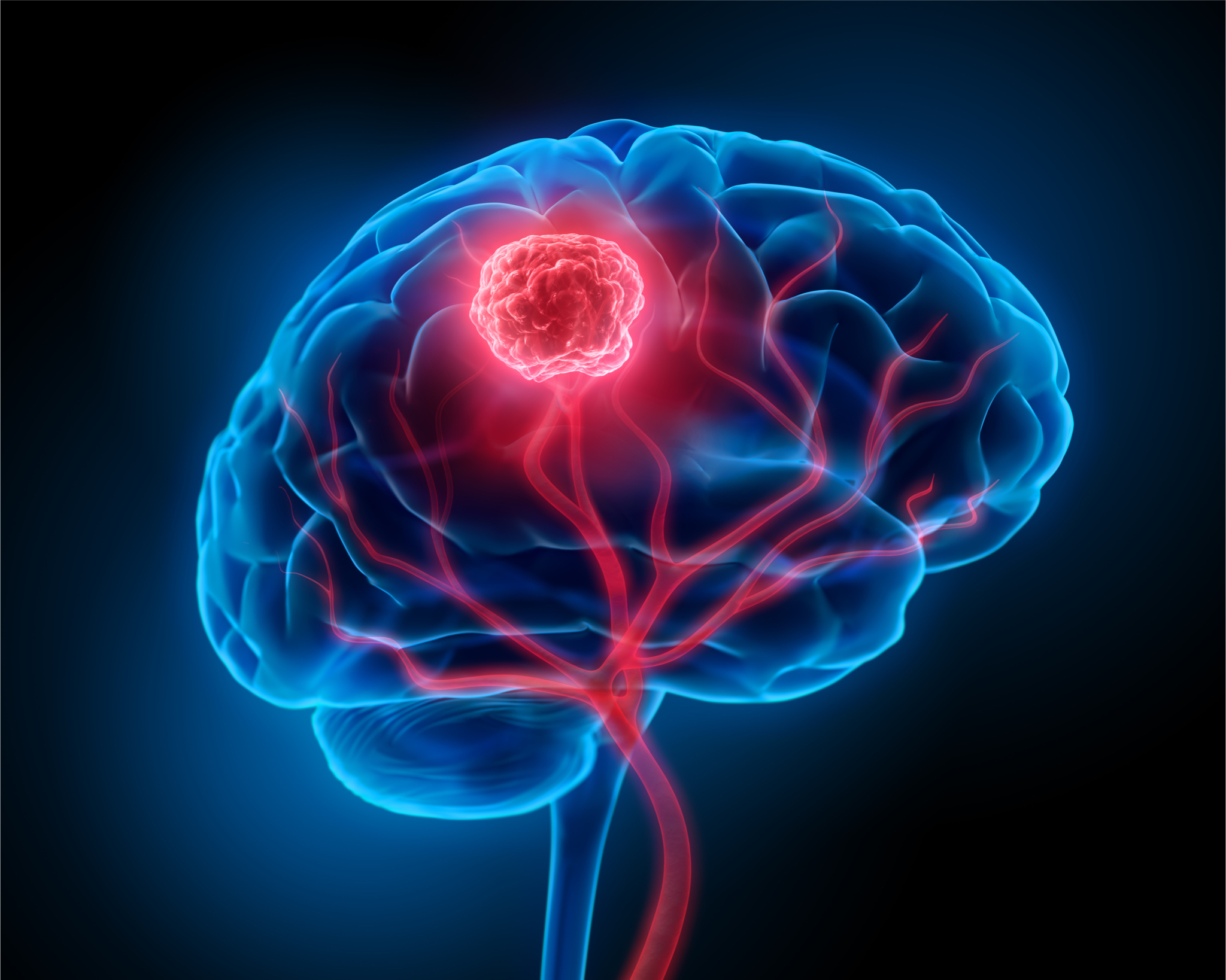 causes-of-brain-tumors